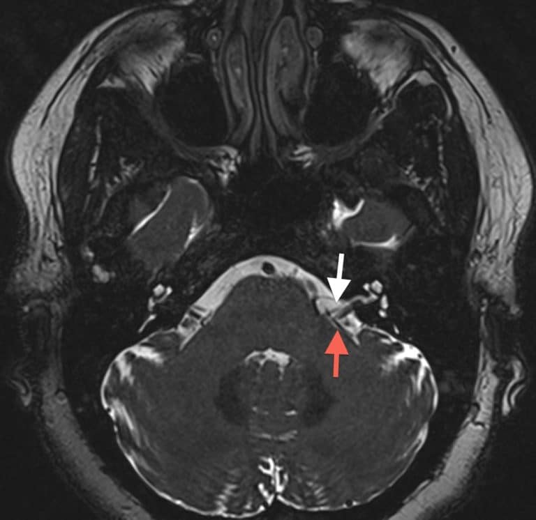 Hemifacial Spasm | New Jersey Brain and Spine