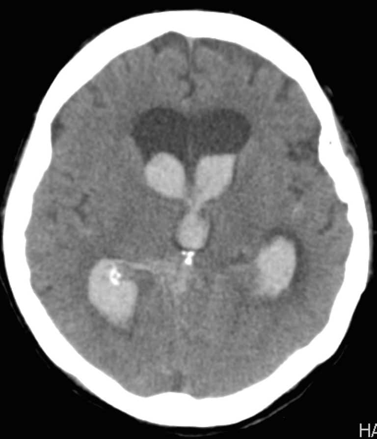 Intra-Ventricular Hemorrhage | New Jersey Brain and Spine