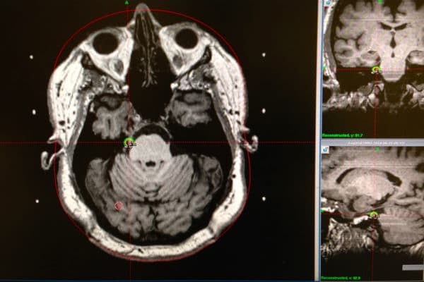 Gamma Knife Radiosurgery for Trigeminal Neuralgia - New Jersey Brain ...